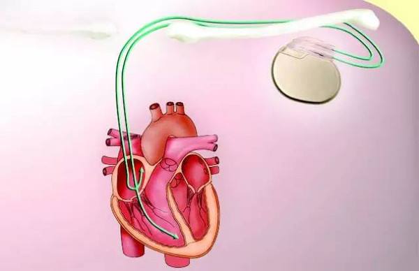 起搏器3類醫(yī)療CE認證
